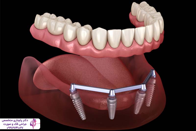 تفاوت اوردنچر و All-on-4