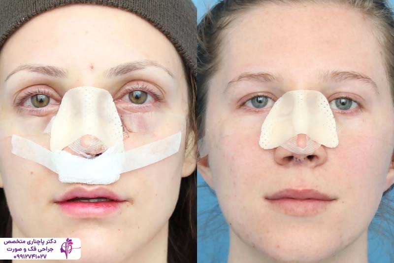 اسپلینت بینی