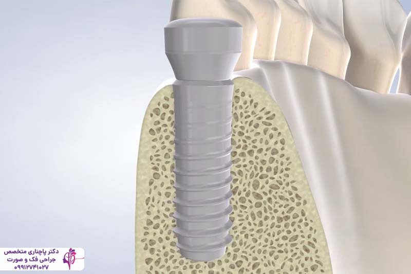 فرآیند استئواینتگریشن در ایمپلنت دندان