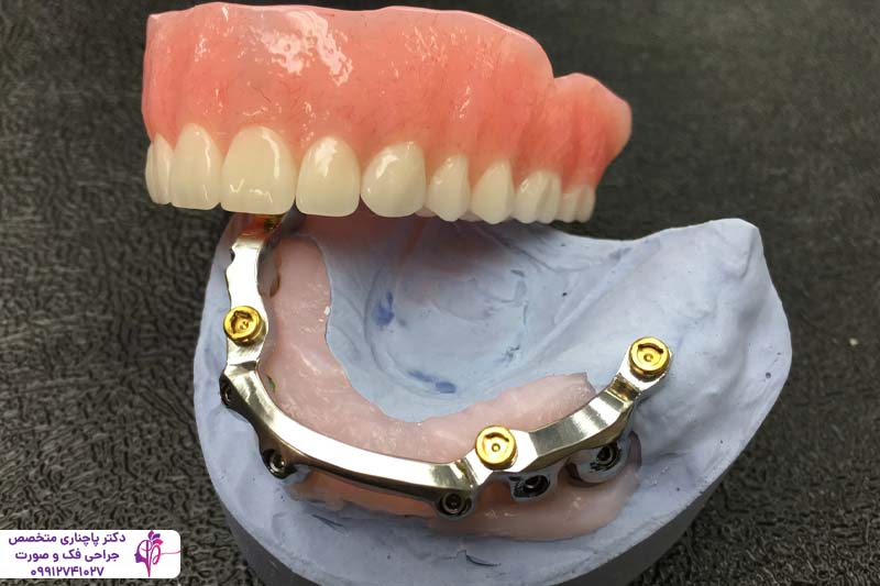 مرکز تخصصی اوردنچر در تهران