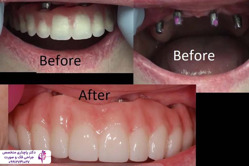 اوردنچر برای سالمندان