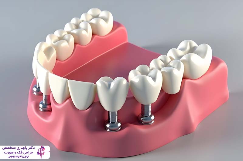 تفاوت اوردنچر و All-on-4