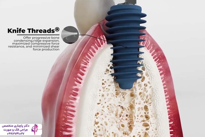 ایمپلنت دندان آلمانی یا سوئیسی