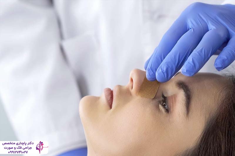 اسپلینت بینی