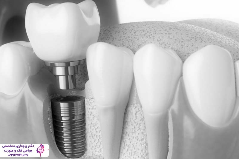 فرآیند استئواینتگریشن در ایمپلنت دندان
