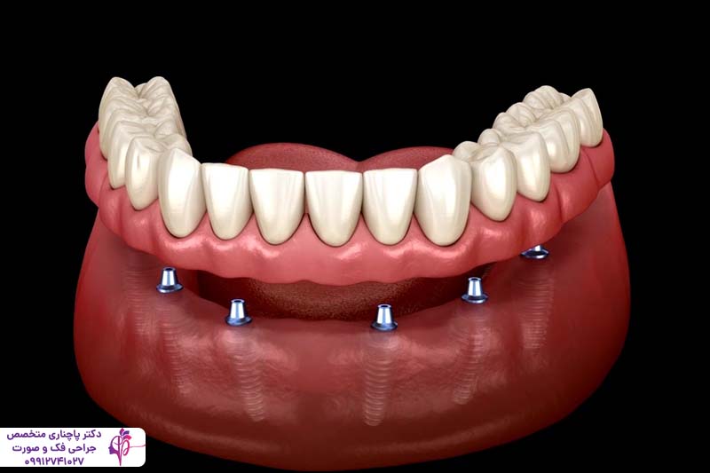 مرکز تخصصی اوردنچر در تهران