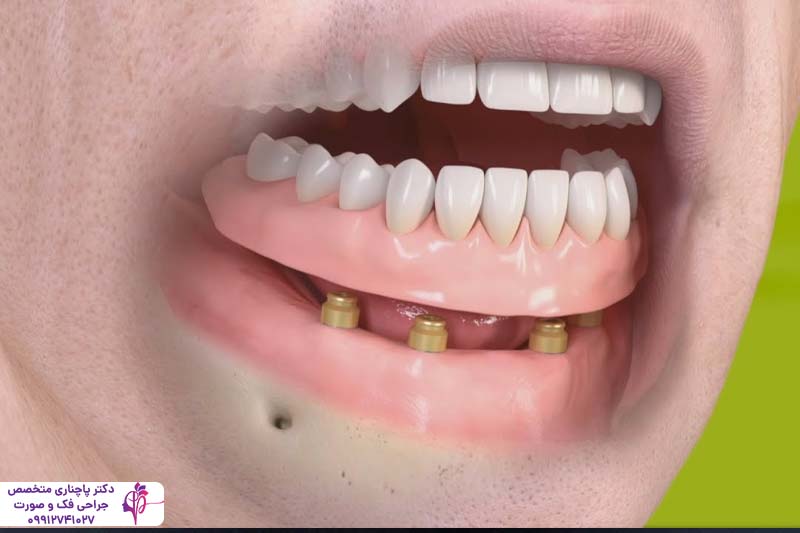 متخصص اوردنچر در زعفرانیه