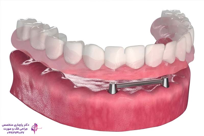 اوردنچر برای سالمندان