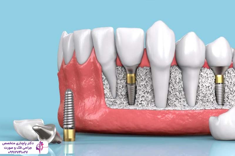 ایمپلنت دندان آلمانی یا سوئیسی