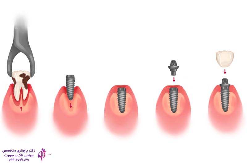فرآیند استئواینتگریشن در ایمپلنت دندان