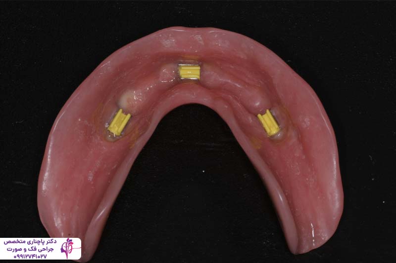 متخصص اوردنچر در زعفرانیه