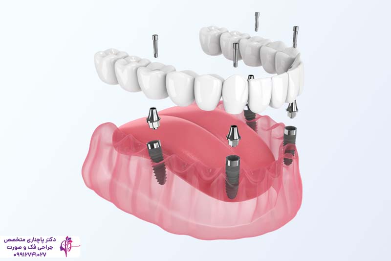 تفاوت اوردنچر و All-on-4