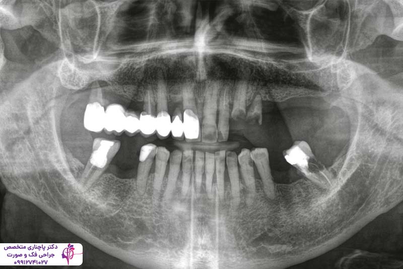 ایمپلنت دندان آلمانی یا سوئیسی