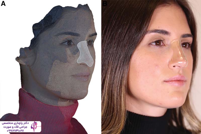 اسپلینت بینی