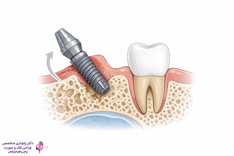 فرآیند استئواینتگریشن در ایمپلنت دندان