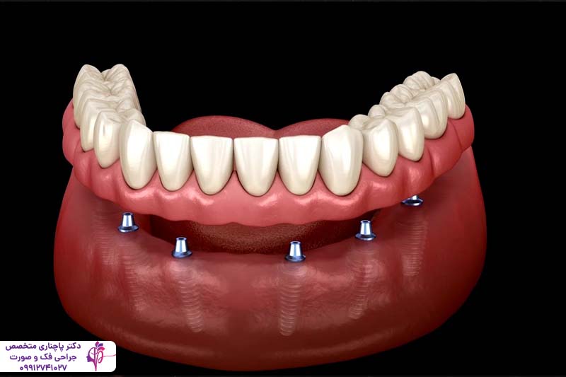 متخصص اوردنچر در زعفرانیه