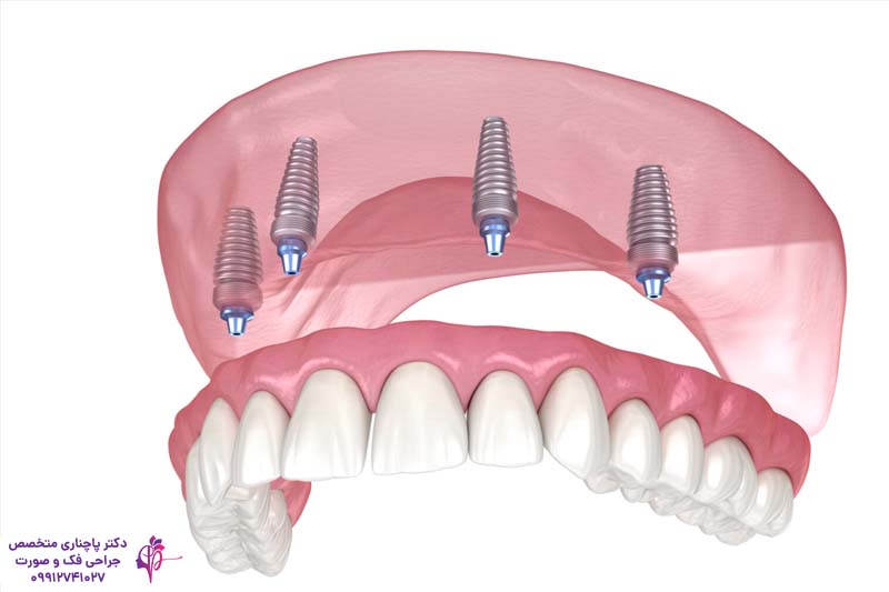 اوردنچر برای سالمندان