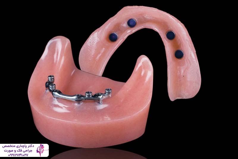 تفاوت اوردنچر و All-on-4