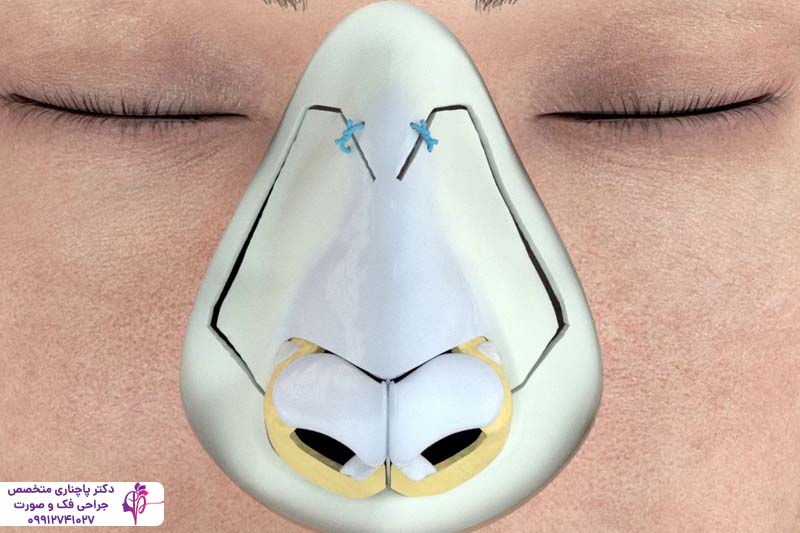 عمل پولیپ بینی همزمان با جراحی رینوپلاستی