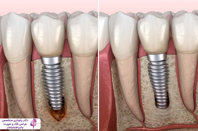 فرآیند استئواینتگریشن در ایمپلنت دندان