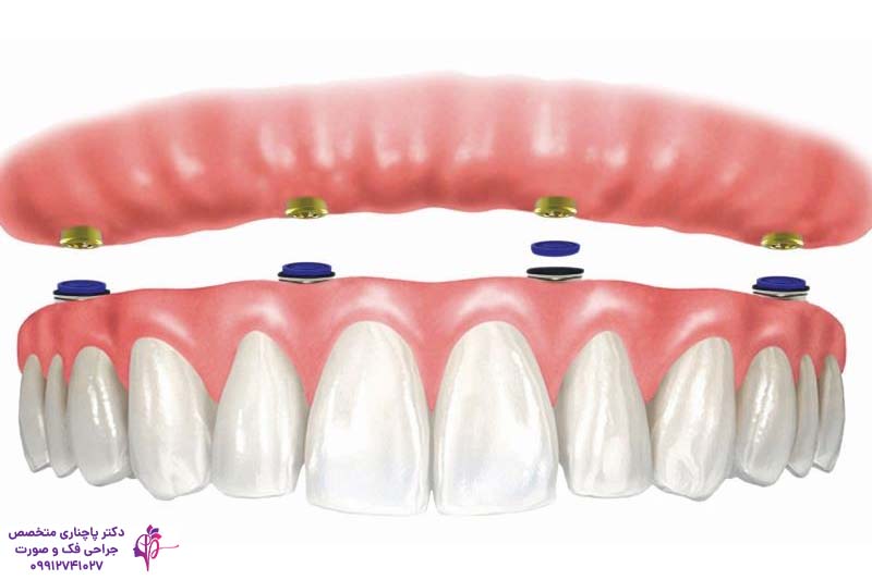 متخصص اوردنچر در زعفرانیه