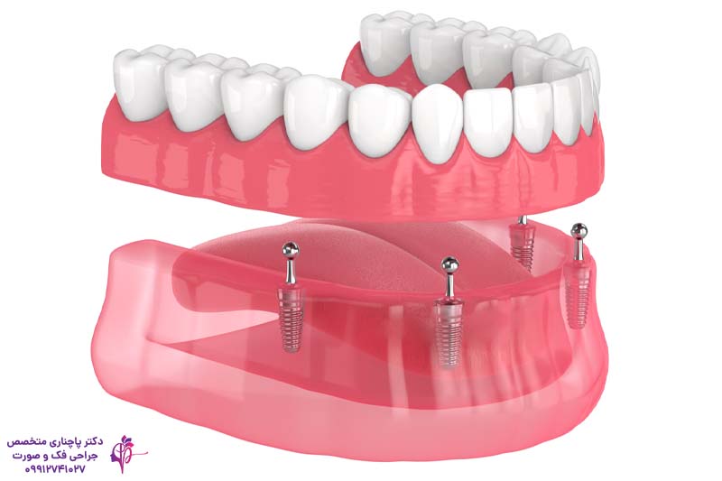 اوردنچر برای سالمندان