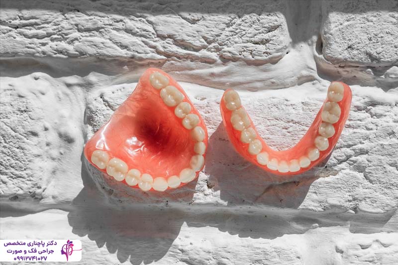 تفاوت اوردنچر و All-on-4