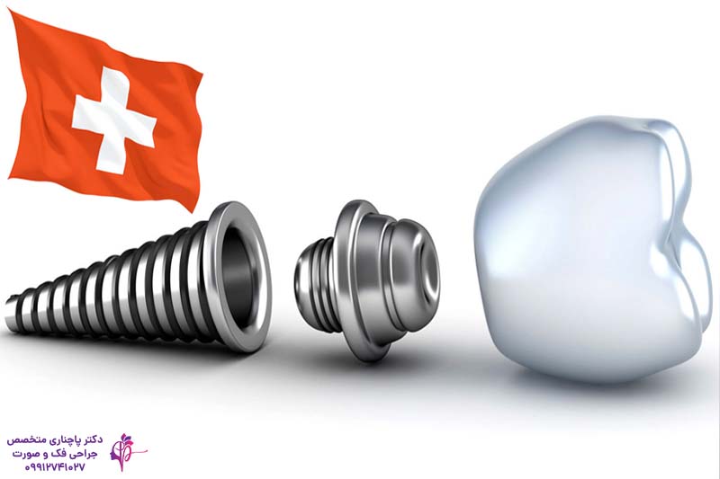 ایمپلنت دندان آلمانی یا سوئیسی