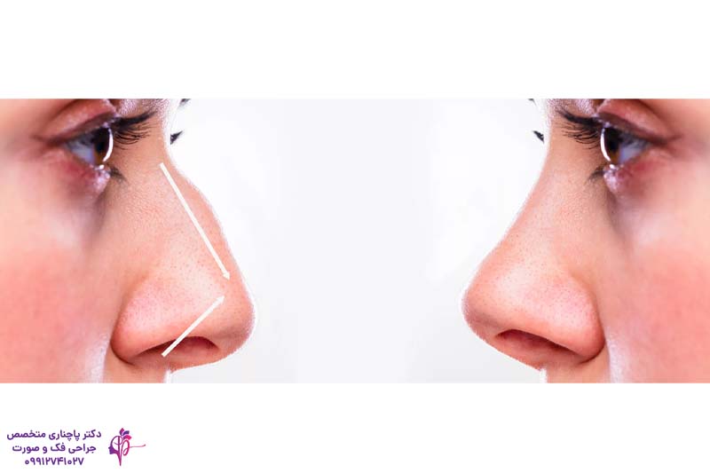 عمل پولیپ بینی همزمان با جراحی رینوپلاستی