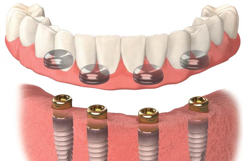 متخصص اوردنچر در زعفرانیه