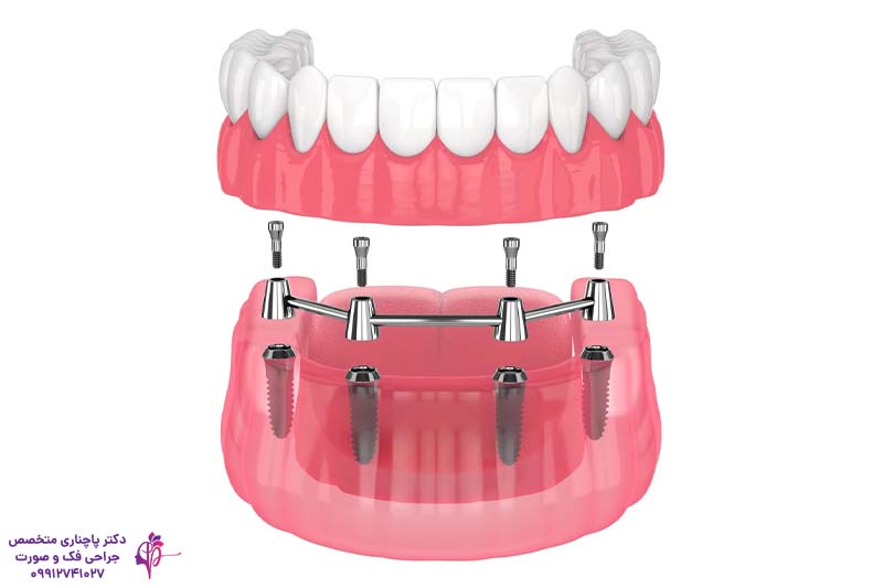 اوردنچر برای سالمندان