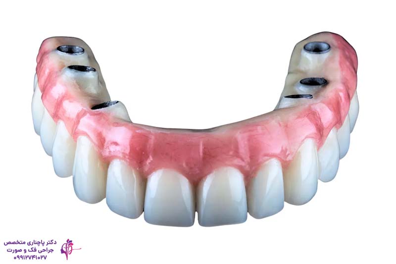 تفاوت اوردنچر و All-on-4