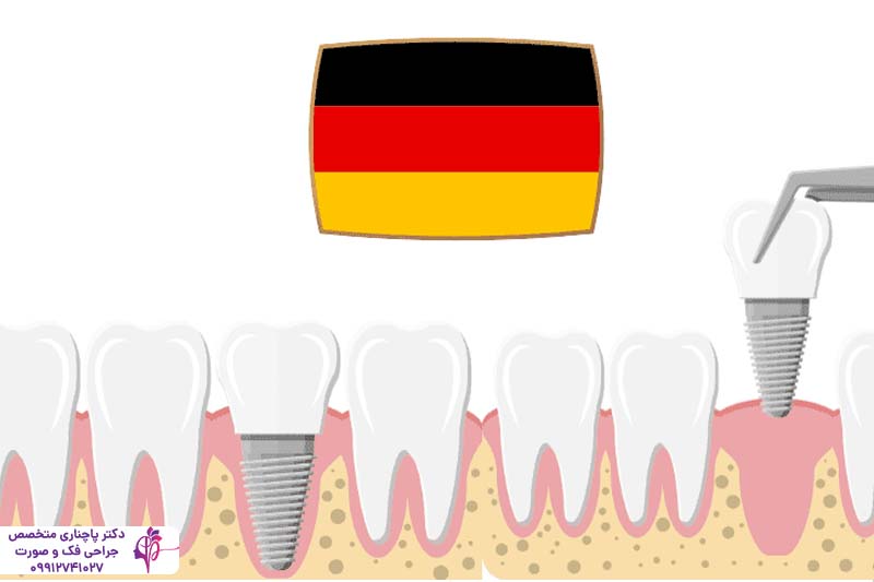 ایمپلنت دندان آلمانی یا سوئیسی