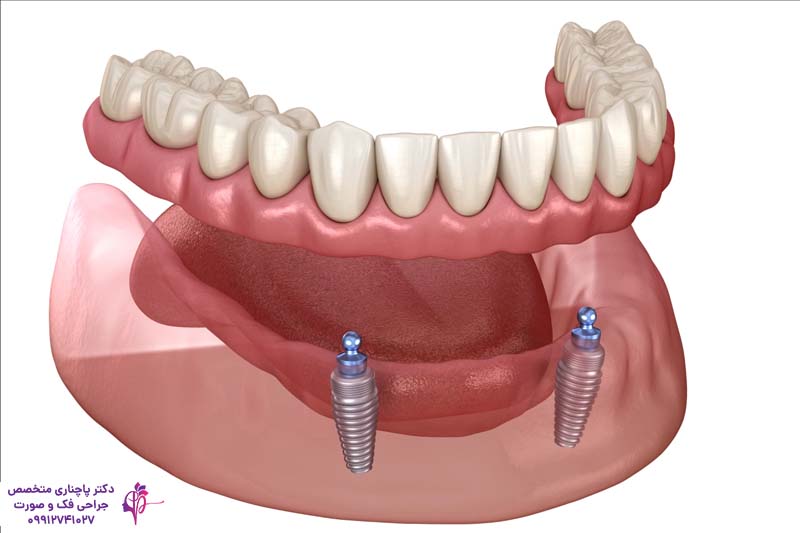 مرکز تخصصی اوردنچر در تهران
