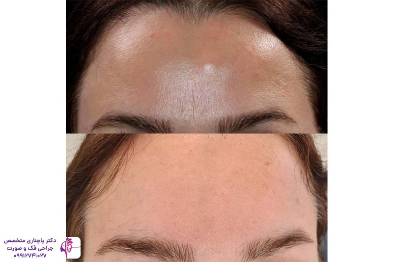 جراحی توده استخوانی پیشانی