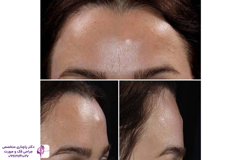 جراحی توده استخوانی پیشانی