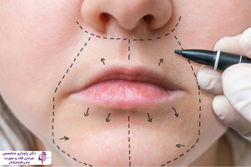 هزینه جراحی لیفت لب