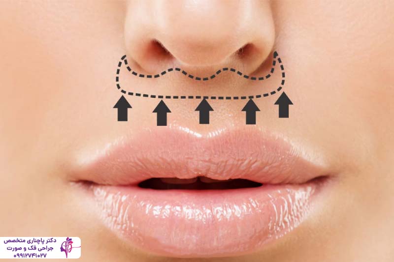هزینه جراحی لیفت لب