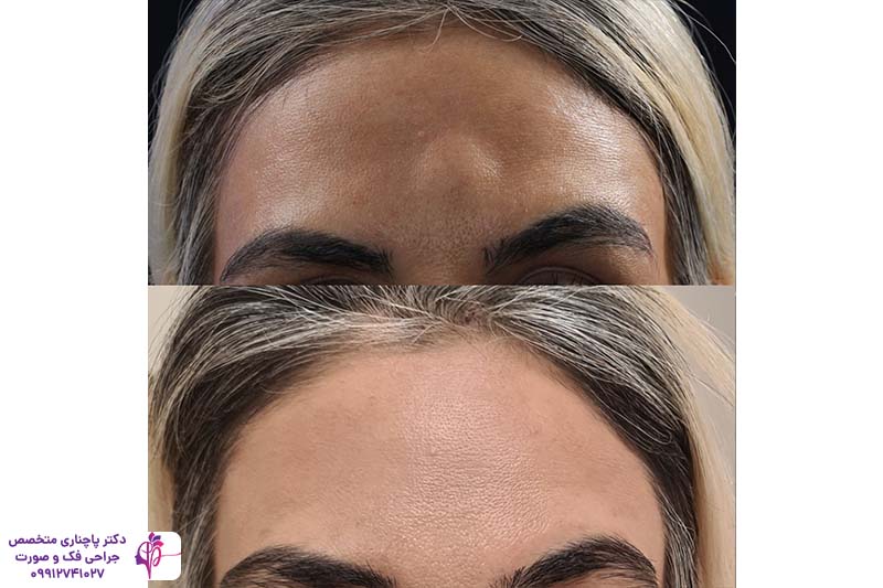 جراحی توده استخوانی پیشانی