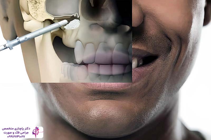 هزینه پیوند سینوس