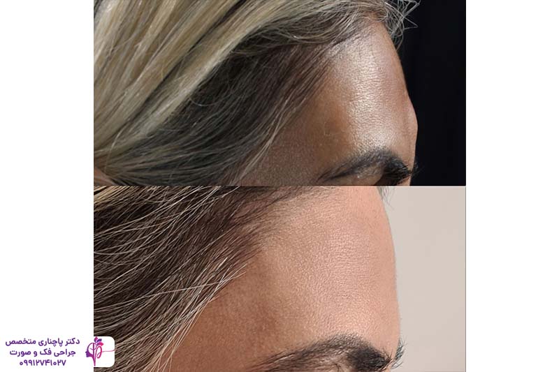 جراحی توده استخوانی پیشانی