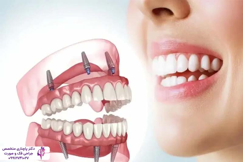 قیمت ایمپلنت کامل فک بالا و پایین