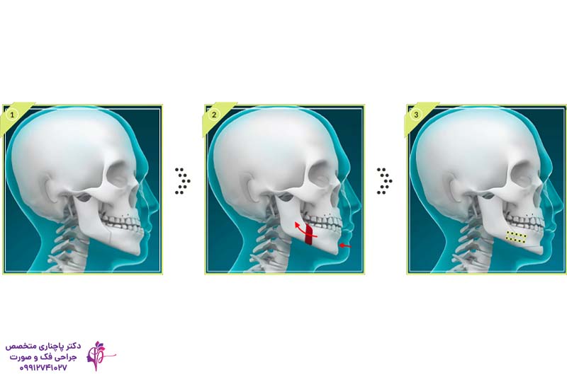 جراحی فک جلو آمده