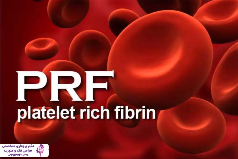 PRF و PRP در ایمپلنت دندان