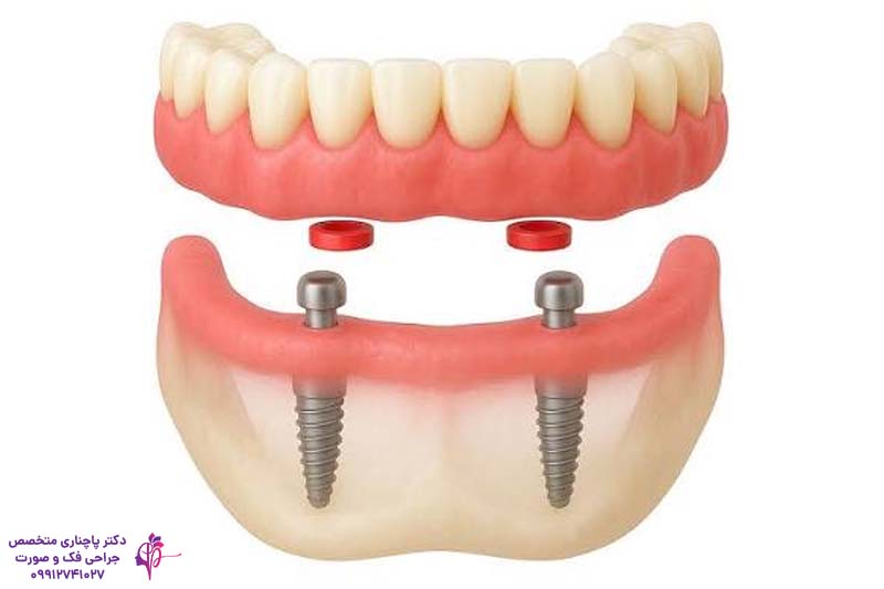 تفاوت ایمپلنت، اوردنچر و ایمپلنت پایه کوتاه